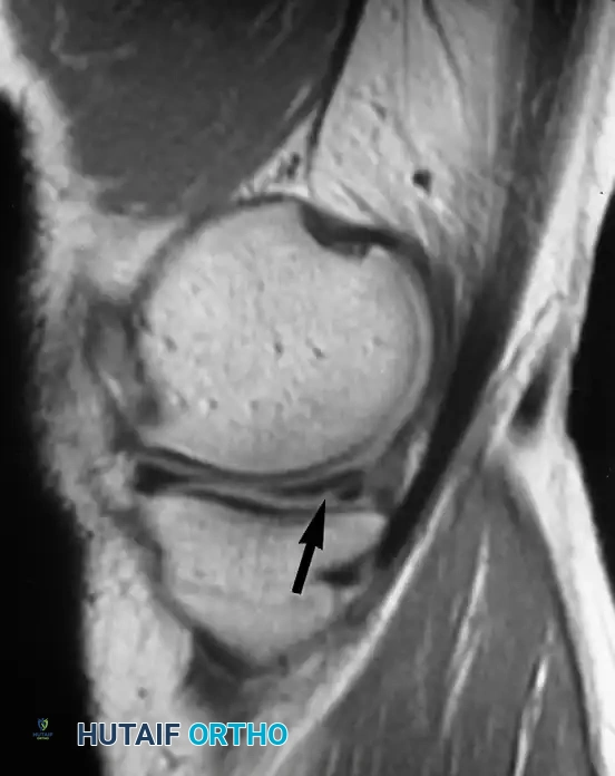 تمزق مائل في القرن الخلفي للغضروف الهلالي الإنسي