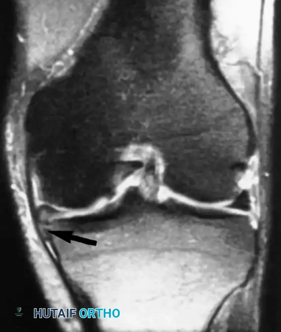 انزياح سفلي لقطعة من الغضروف الهلالي الإنسي تحت الأربطة
