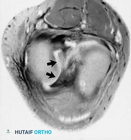 صورة مقطعية توضح الجزء المنزاح من الغضروف الهلالي