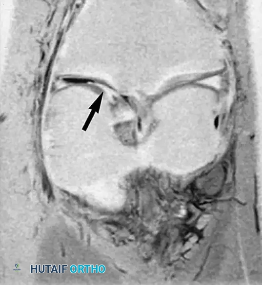 تمزق يد الدلو مع انزياح جزء من الغضروف لمنتصف الركبة
