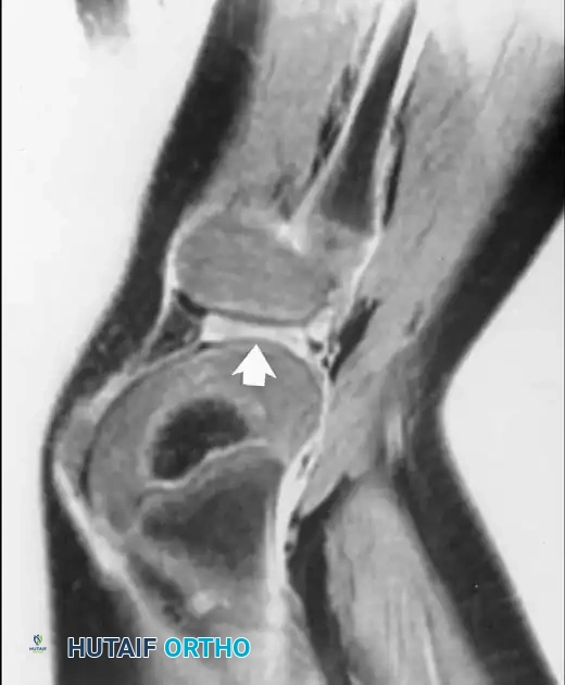 غضروف هلالي قرصي سميك بشكل غير طبيعي لدى طفل