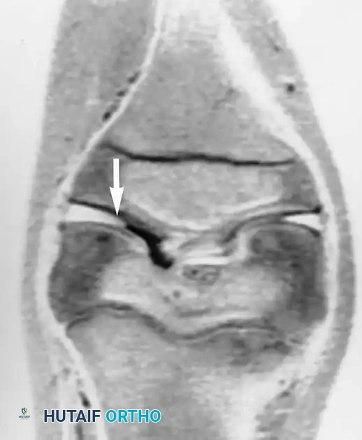 امتداد الغضروف القرصي ليغطي مساحة أكبر من المفصل