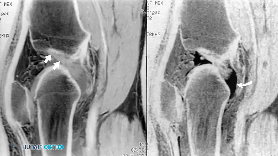 تمزق حاد في الرباط الصليبي الأمامي مع تغير زاوية الرباط