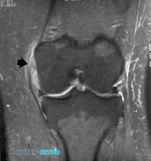 صورة رنين مغناطيسي تؤكد سلامة الأربطة الصليبية والجانبية للتقييم قبل الجراحة