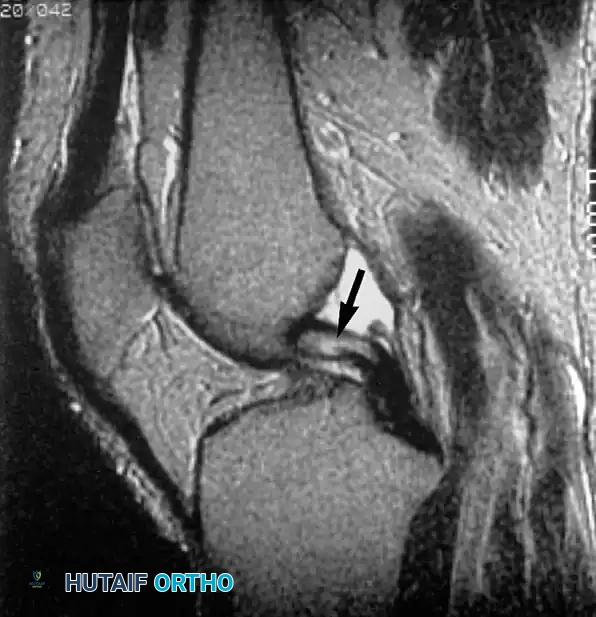 تجمع السوائل في مكان انقطاع الرباط الصليبي من عظمة الفخذ
