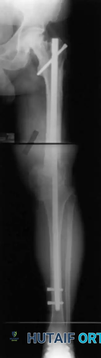 Long IM Nail X-Ray