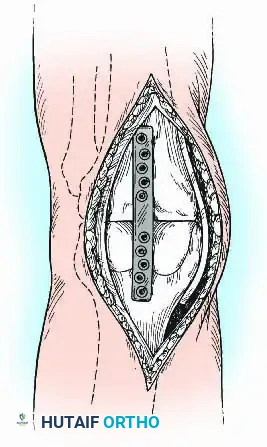 Additional Plating Context