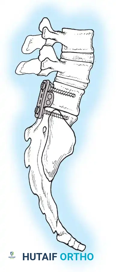 KYPHOSCOLIOSIS Surgical Diagram