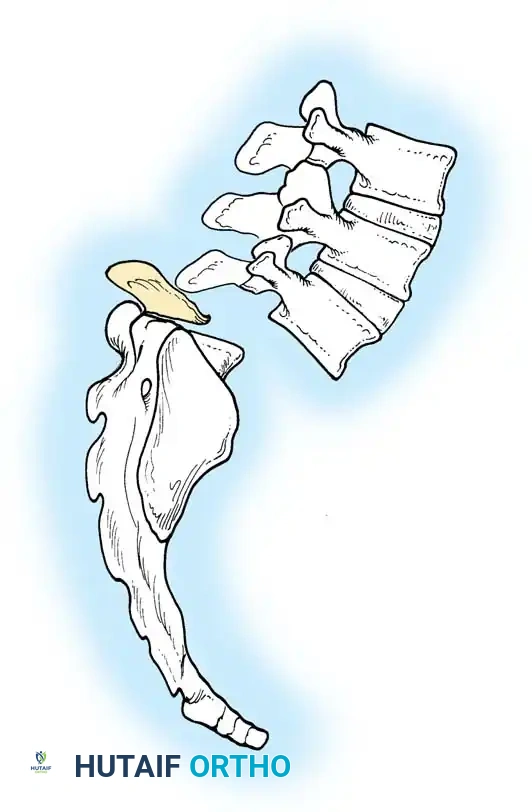 KYPHOSCOLIOSIS Surgical Diagram