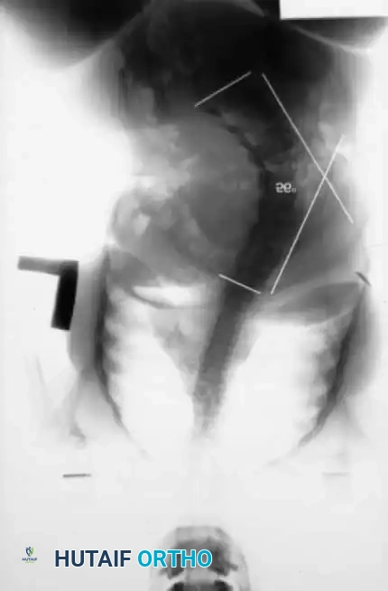 KYPHOSCOLIOSIS Surgical Diagram