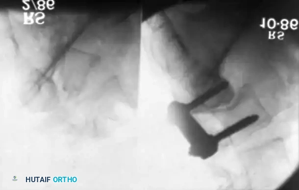 KYPHOSCOLIOSIS Surgical Diagram