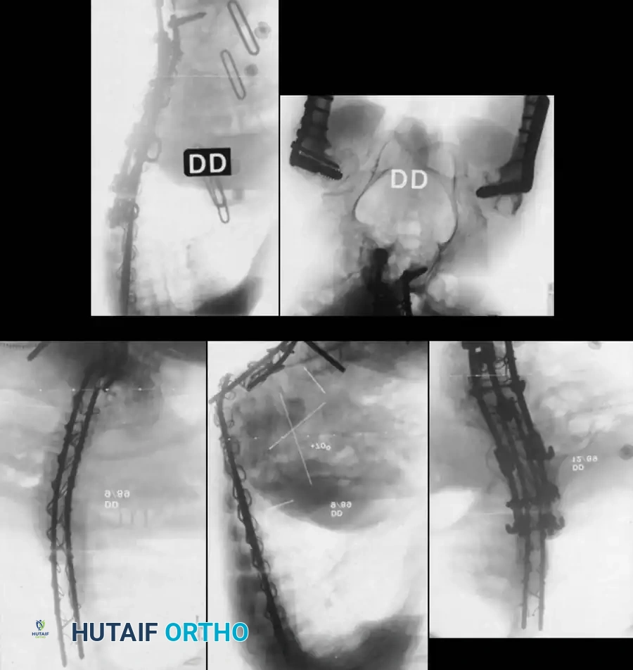 KYPHOSCOLIOSIS Surgical Diagram