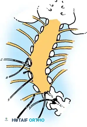 KYPHOSCOLIOSIS Surgical Diagram