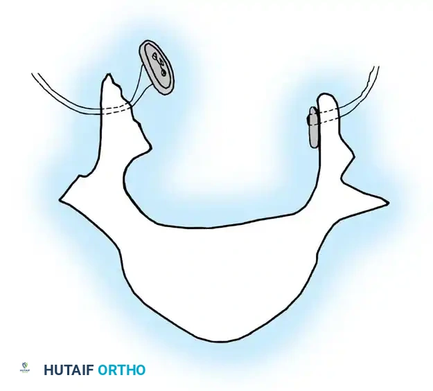 KYPHOSCOLIOSIS Surgical Diagram
