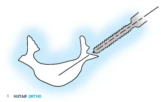 KYPHOSCOLIOSIS Surgical Diagram