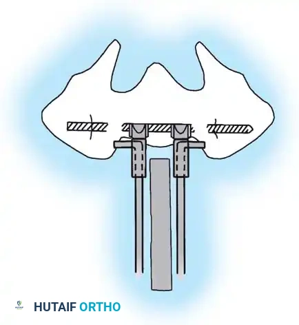 KYPHOSCOLIOSIS Surgical Diagram