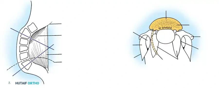 KYPHOSCOLIOSIS Surgical Diagram