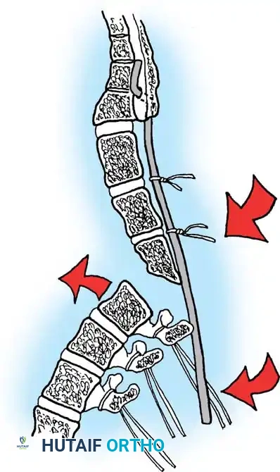KYPHOSCOLIOSIS Surgical Diagram