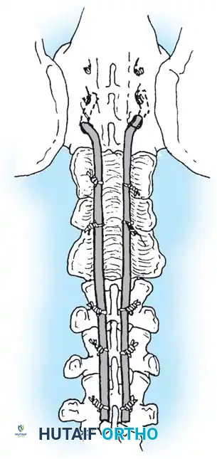 KYPHOSCOLIOSIS Surgical Diagram