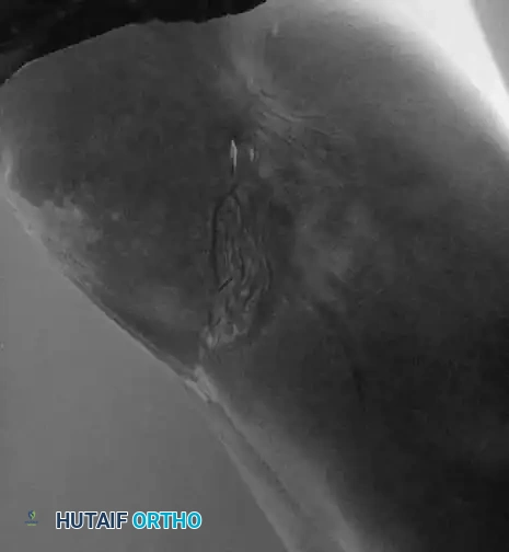 KYPHOSCOLIOSIS Surgical Diagram