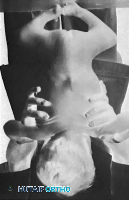 KYPHOSCOLIOSIS Surgical Diagram