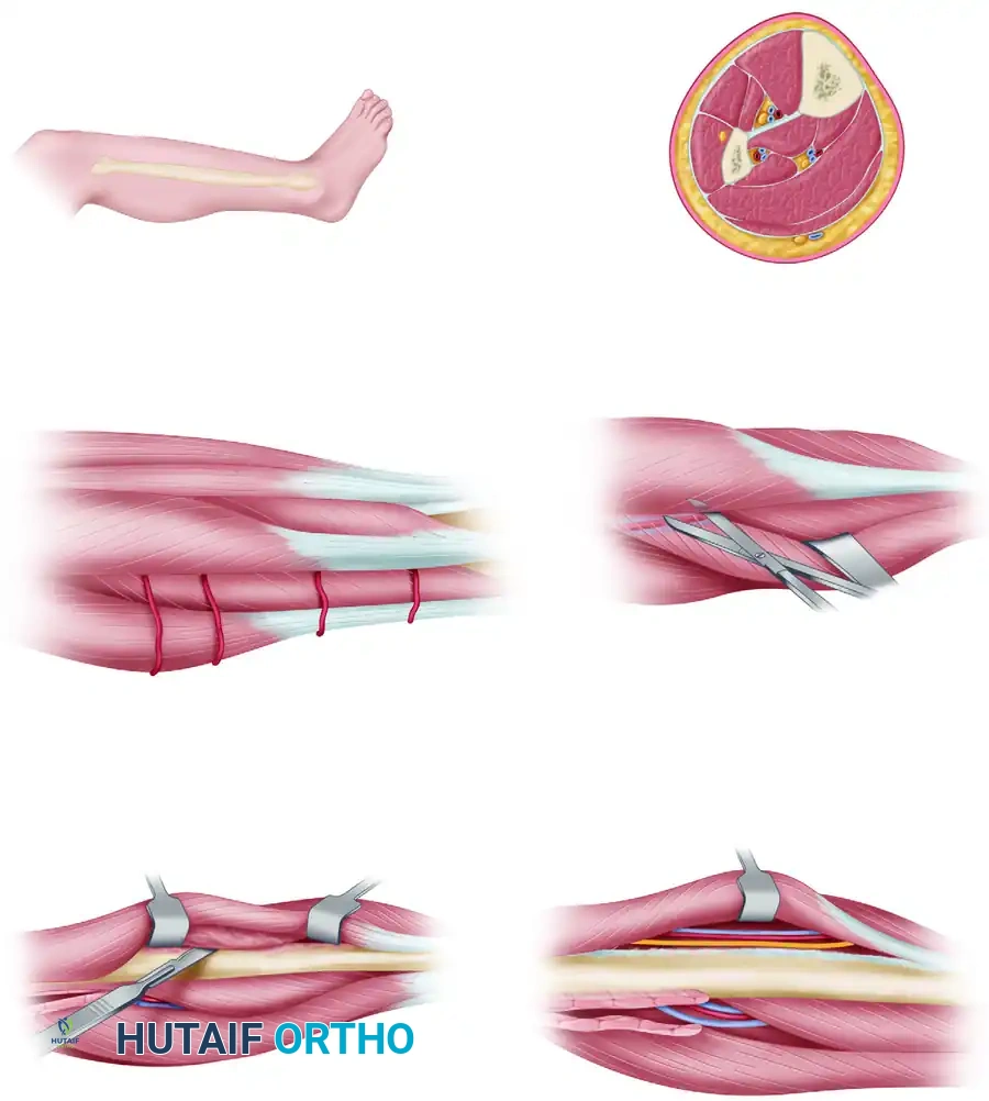 LATERAL APPROACH FOR HARVESTING FIBULAR GRAFT Surgical Diagram