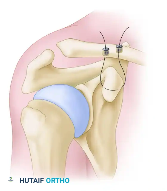LATERAL CLAVICULAR FRACTURES Surgical Diagram