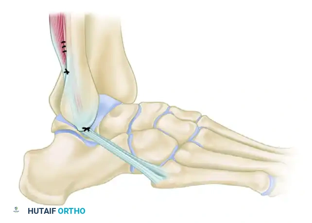رسم توضيحي لتقنية إيفانز الجراحية التي تمرر الوتر عبر نفق عظمي واحد في الشظية مقارنة بتقنية واتسون جونز