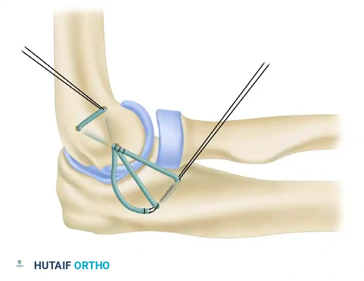 LATERAL ULNAR COLLATERAL LIGAMENT RECONSTRUCTION FOR POSTEROLATERAL ROTATORY INSTABILITY Surgical Diagram