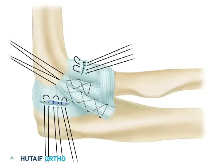 LATERAL ULNAR COLLATERAL LIGAMENT RECONSTRUCTION FOR POSTEROLATERAL ROTATORY INSTABILITY Surgical Diagram