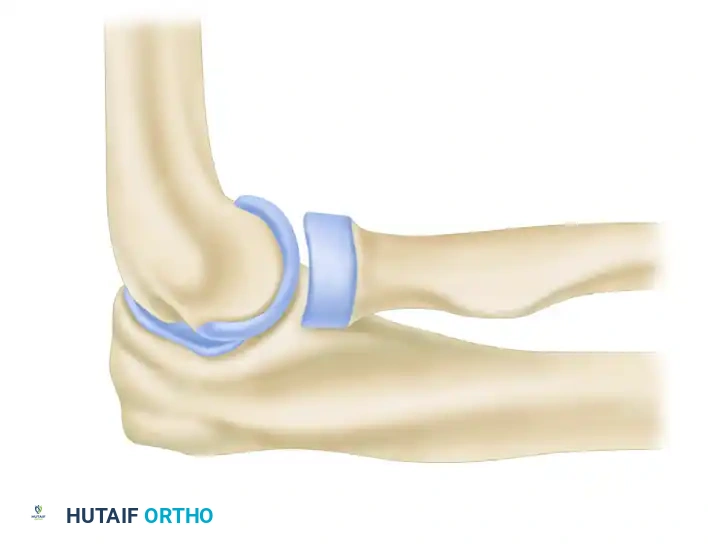 LATERAL ULNAR COLLATERAL LIGAMENT RECONSTRUCTION FOR POSTEROLATERAL ROTATORY INSTABILITY Surgical Diagram