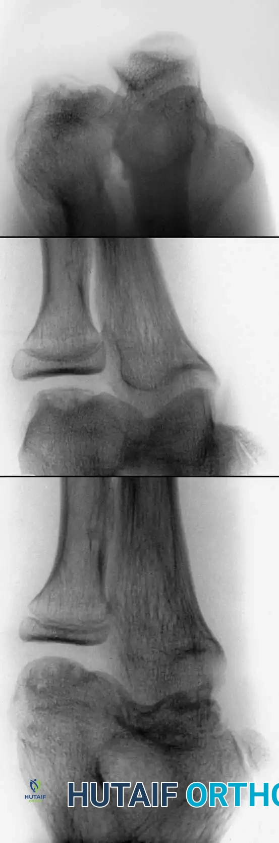 Legg-Calvé-Perthes Disease: Pathogenesis, Classification, and Surgical Management