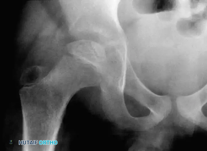 Fig. 29-19 Type B subchondral fracture involving more than 50% of femoral head.