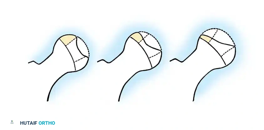 LEGG-CALVÉ-PERTHES DISEASE Surgical Diagram