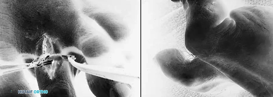 Flexible hammer toe transfer