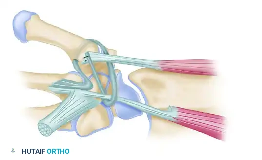 Eaton-Littler Ligament Reconstruction Diagram