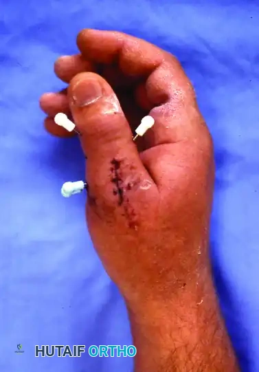 Clinical Image of Capped Wires