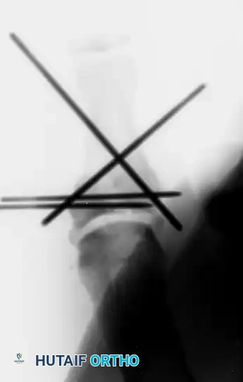 Postoperative Lateral X-ray