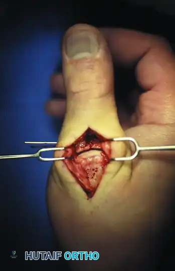 Preoperative Lateral X-ray