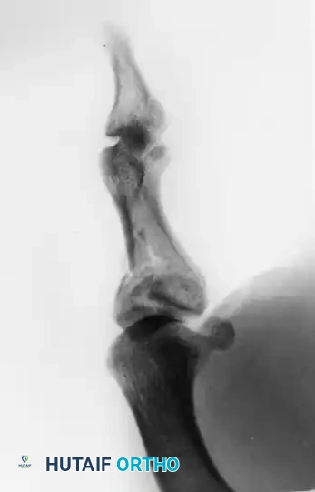 Postoperative AP X-ray