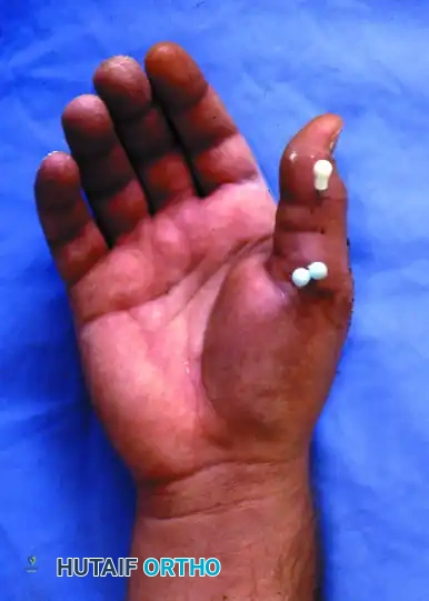 Clinical Image of Capped Wires Lateral