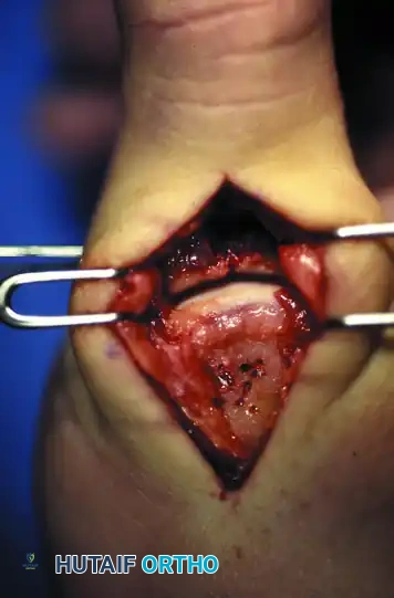 Intraoperative Exposure