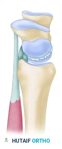 Scapholunate Ligament Reconstruction: Advanced Surgical Techniques and Biomechanics