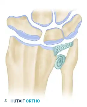 LIMITED ULNAR HEAD EXCISION: HEMIRESECTION INTERPOSITION ARTHROPLASTY Surgical Diagram
