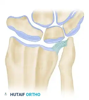 LIMITED ULNAR HEAD EXCISION: HEMIRESECTION INTERPOSITION ARTHROPLASTY Surgical Diagram