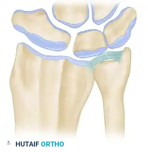 LIMITED ULNAR HEAD EXCISION: HEMIRESECTION INTERPOSITION ARTHROPLASTY Surgical Diagram