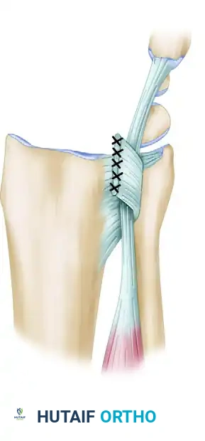 Hemiresection Interposition Arthroplasty: Bowers Technique
