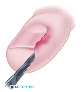 LONG-TERM FOLLOW-UP Surgical Diagram