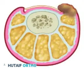 LONG-TERM FOLLOW-UP Surgical Diagram
