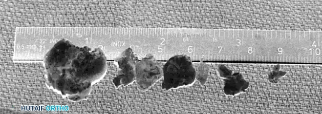 LOOSE BODIES Surgical Diagram